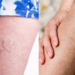 Spider Veins vs. Varicose Veins: Knowing the Difference