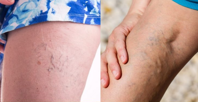 Spider Veins vs. Varicose Veins: Knowing the Difference